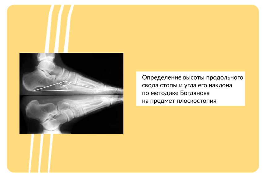 Рисунок. Определение степени плоскостопия